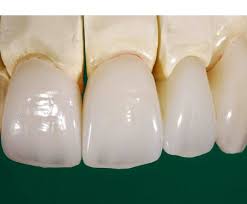 Sứ Ceramill ZI ZOLID FX